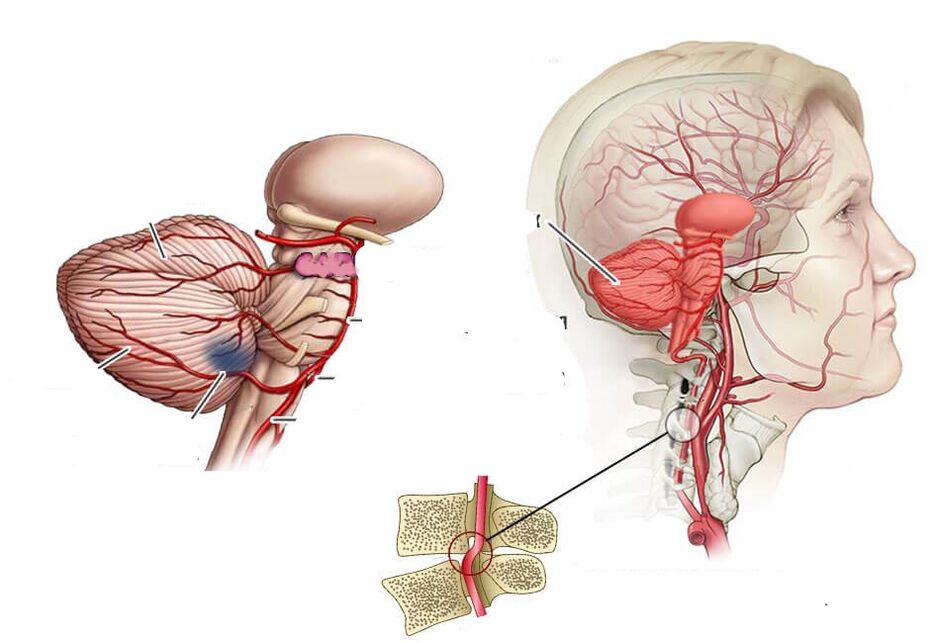 Ischemia cerebellare